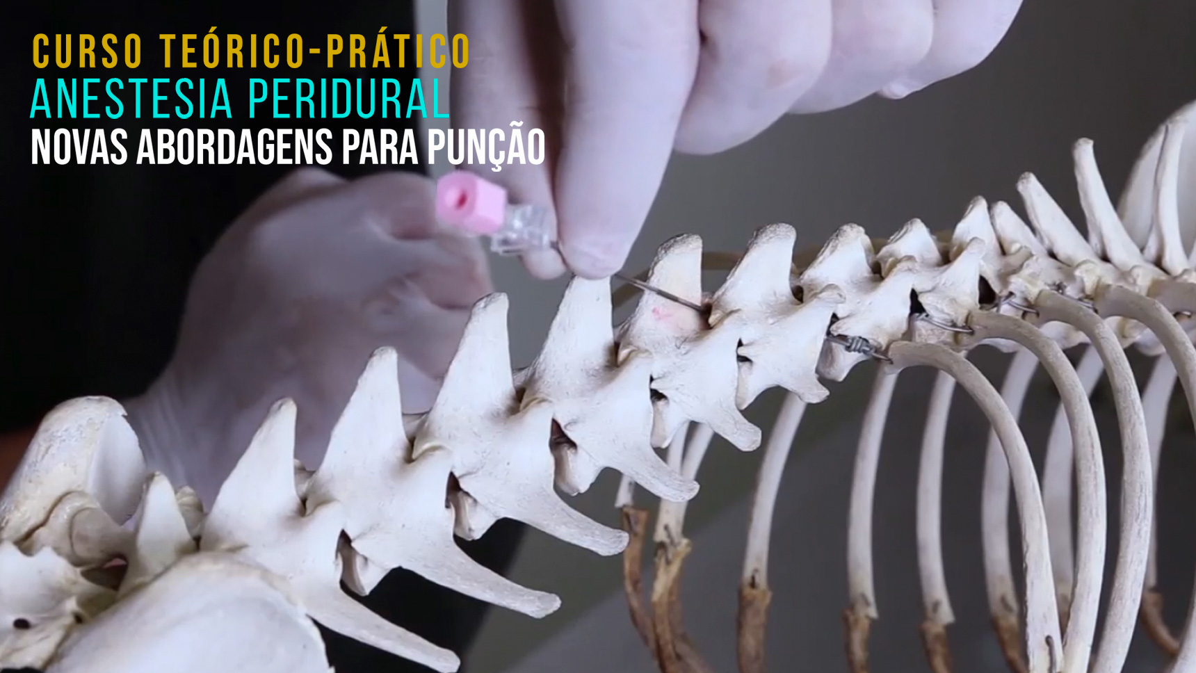 Curso Prático de Anestesia Peridural Novas Abordagens para Punção